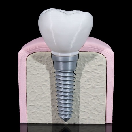 Implant Diş Modeli
