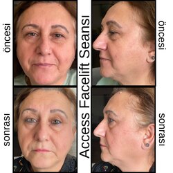 Access Facelift 10 Seans