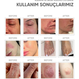 Dermotitte Egzama ve Sedefe Eğilimli Ciltler  Onarıcı ve yatıştırıcı Bakım Kremi 