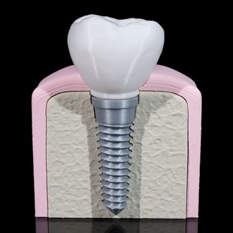 Implant Diş Modeli