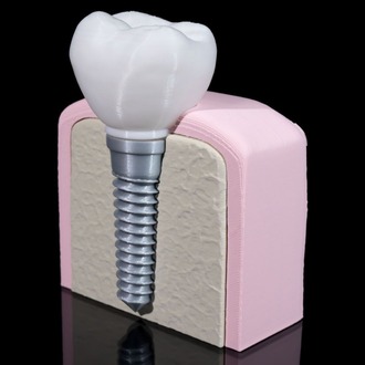 Implant Diş Modeli
