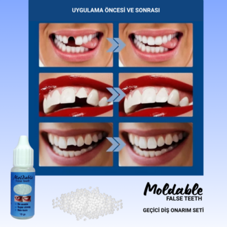 Moldable Diş Onarım Seti (20g) - 70+ Diş Kapasiteli Geçici Dolgu ve Protez Kiti