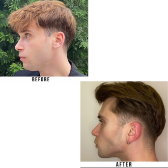 Jawline Master Program | Bilimsel & Güvenli Çene Hattı Gelişim Planı