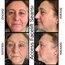 Access Facelift Seansı