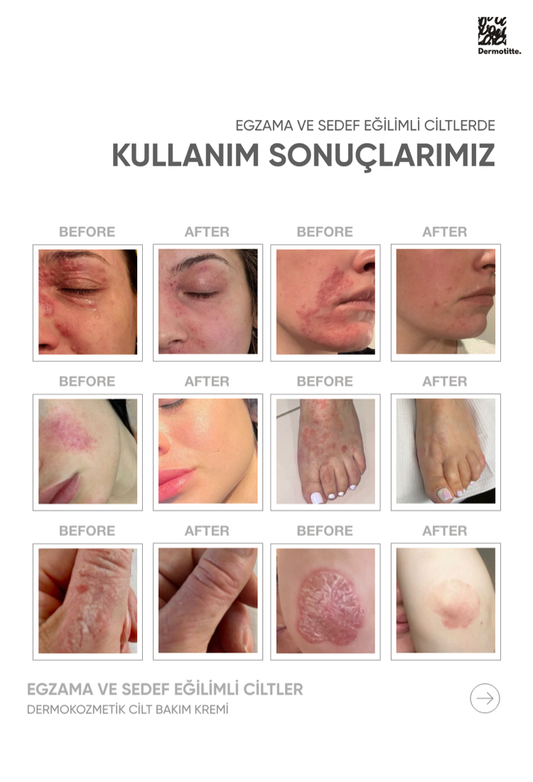Dermotitte Egzama ve Sedefe Eğilimli Ciltler  Onarıcı ve yatıştırıcı Bakım Kremi 