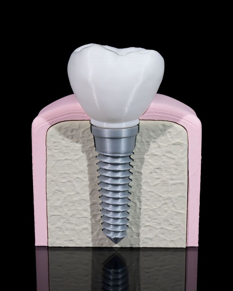 Implant Diş Modeli