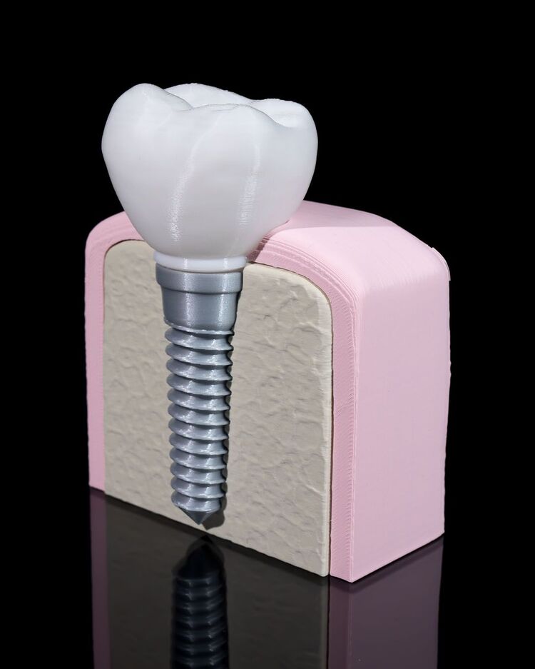 Implant Diş Modeli